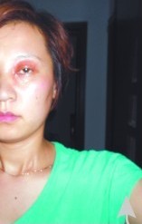女子眼球慘遭開水燙 眼科醫(yī)生睡覺稱雙休日治不了 女子眼球慘遭開水燙 眼科醫(yī)生睡覺稱雙休日治不了