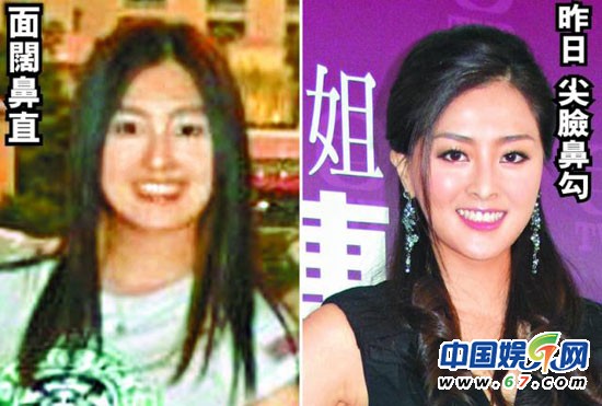 有人爆料指張名雅做過四次整形手術(shù)，還提供了一張疑似張名雅的舊照(左圖)