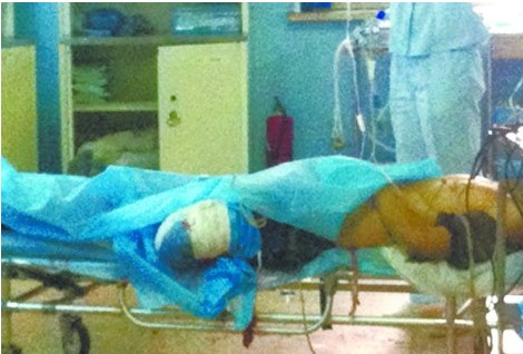 小伙左大腿被軋斷只剩一截 血染紗布痛苦嚎叫 小伙左大腿被軋斷只剩一截 血染紗布痛苦嚎叫